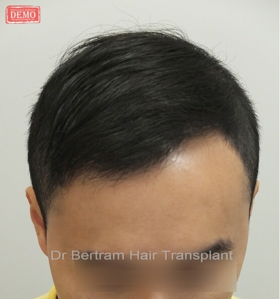 Before and After Hair Transplant Dr Bertram Hair Transplant